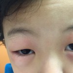 突然、子供の目が腫れ、かゆみを訴えた!原因は・・・?