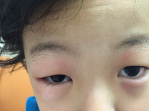 突然、子供の目が腫れ、かゆみを訴えた！原因は・・・？