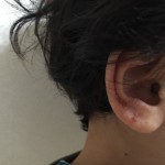 子供の耳の湿疹が!いつまでも治らない、これは何?