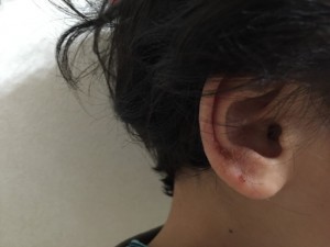 子供の耳の湿疹が!いつまでも治らない、これは何?